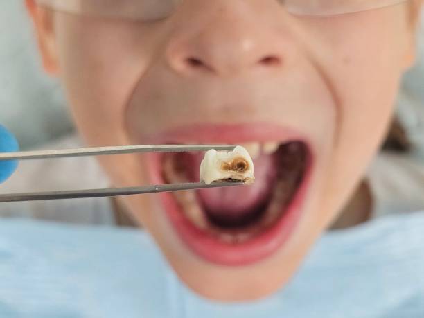 Best Emergency Dentist for Lost Fillings or Crowns in Lansdale, PA